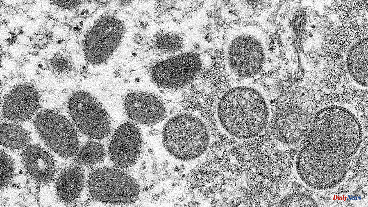 After confirmed case: Sweden declares monkeypox dangerous to the public