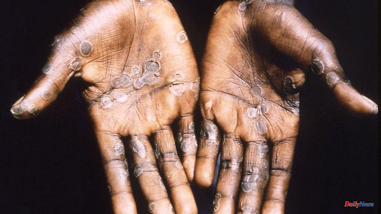 First case in Germany: How dangerous is the monkeypox outbreak?