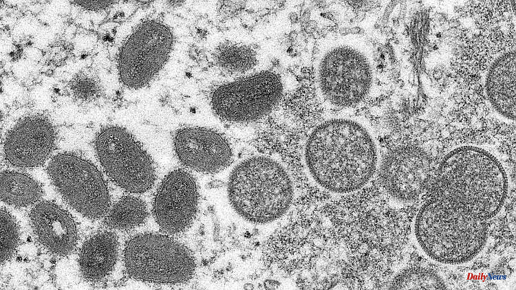 Sexual transmission conceivable: Researchers find monkeypox viruses in semen