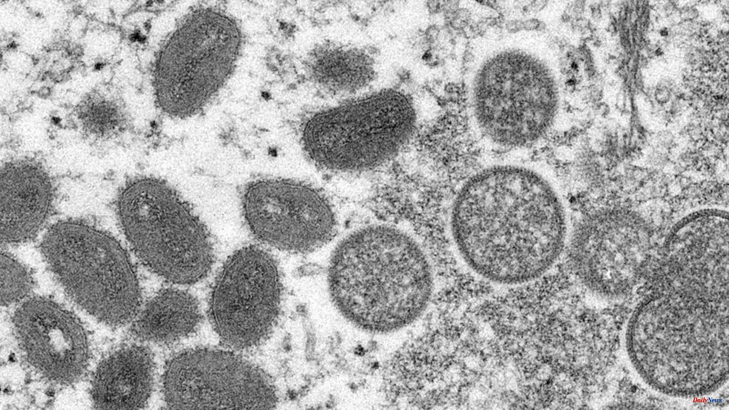 Health: More than 2000 cases of monkeypox in Germany