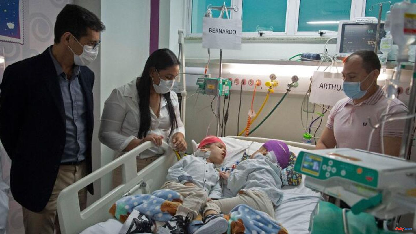 Brazil: Conjoined conjoined twins separated at the head in several surgeries