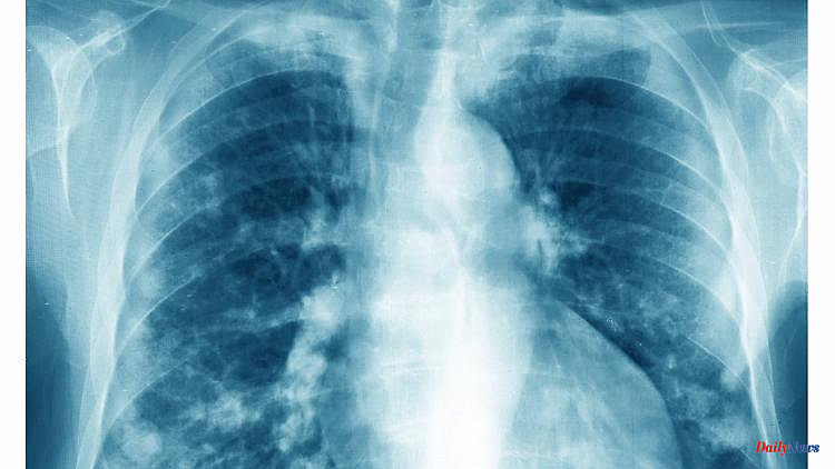 Use of fossil fuels: Possible cause of lung cancer in non-smokers discovered