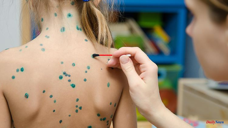 Measles, scarlet fever, chickenpox: which rash for which disease?