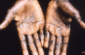 Global health emergency: how to protect yourself from monkeypox