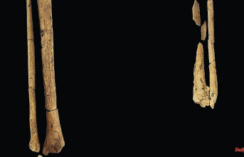 One-footed Stone Age man: amputation proven 31,000 years ago