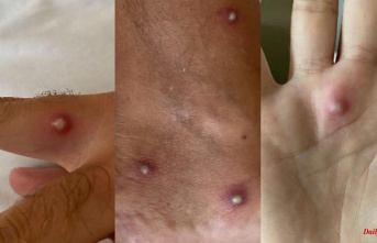 Only a few cases recorded: monkeypox outbreak in Germany ebbs