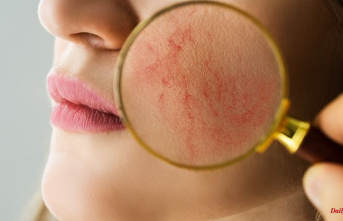 When the Face Blushes: The Difficult Treatment of Rosacea