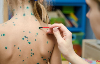Measles, scarlet fever, chickenpox: which rash for which disease?