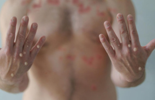 Virus: monkeypox - hospital society calls for awareness...
