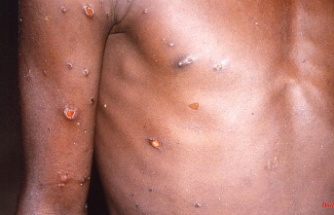 For infected and risk groups: Great Britain vaccinates against monkeypox